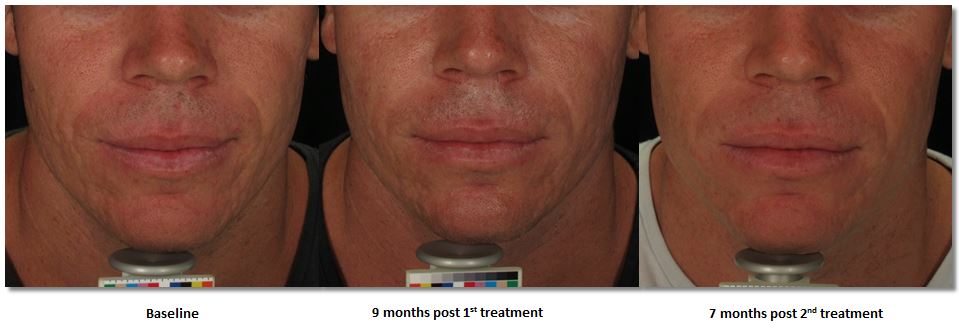 Acne scar treatment - uRepublic 