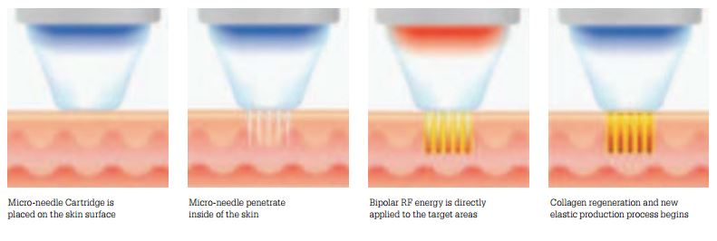 Radiofrequency