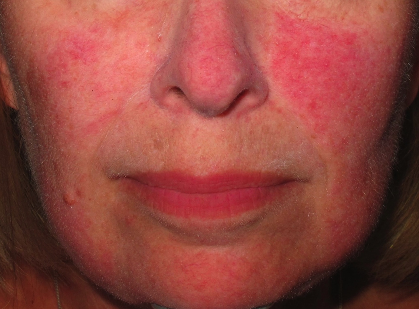 Blotchy Skin Laser Treatments for Redness Pigmentation Sydney