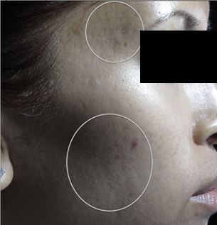 Acne Scar Repair