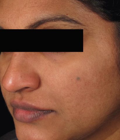 Laser Resurfacing – SELLAS (fractionated laser)