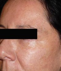 Laser Resurfacing – SELLAS (fractionated laser)