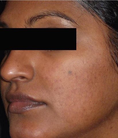 Laser Resurfacing – SELLAS (fractionated laser)