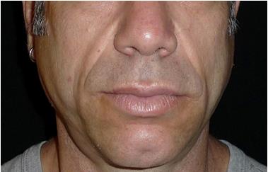 Mid-facial volume loss - After