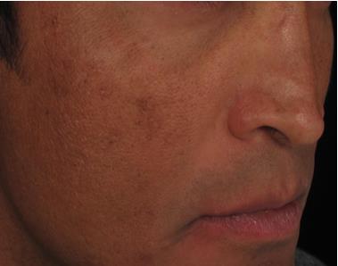 Pico laser - After 3 treatments