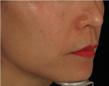 Pico laser - After treatment