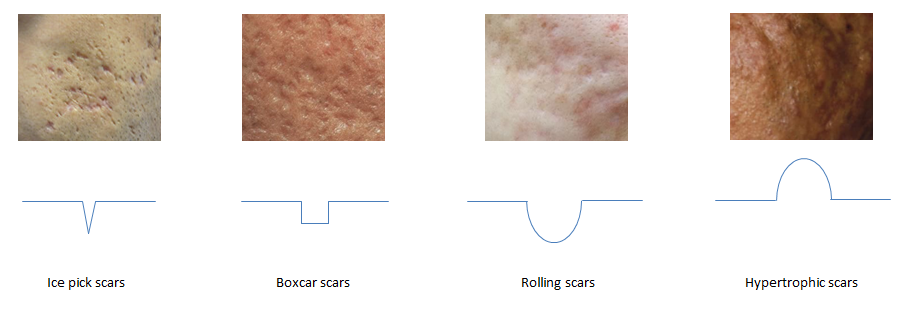 hypertrophic acne scar